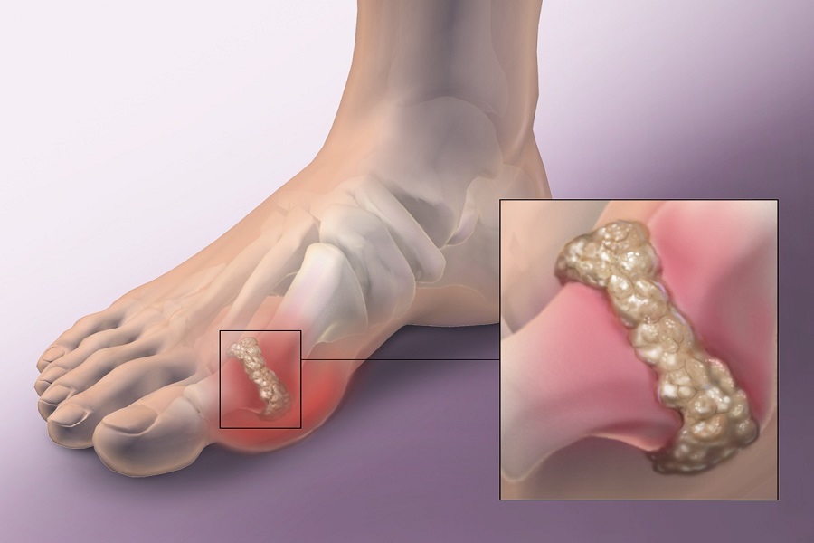 Nên tích cực điều trị thoái hóa khớp trước khi bệnh nặng hơn