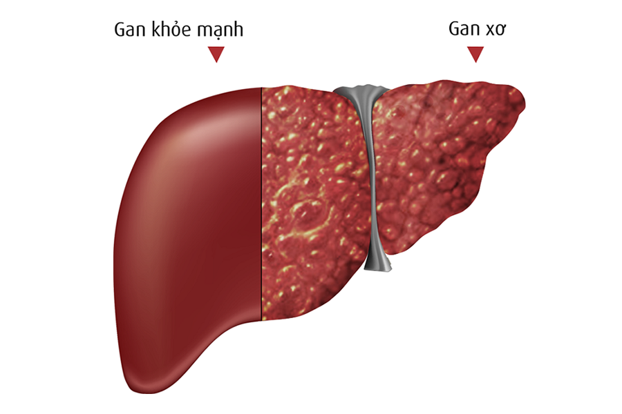 Dấu hiệu nhận biết xơ gan