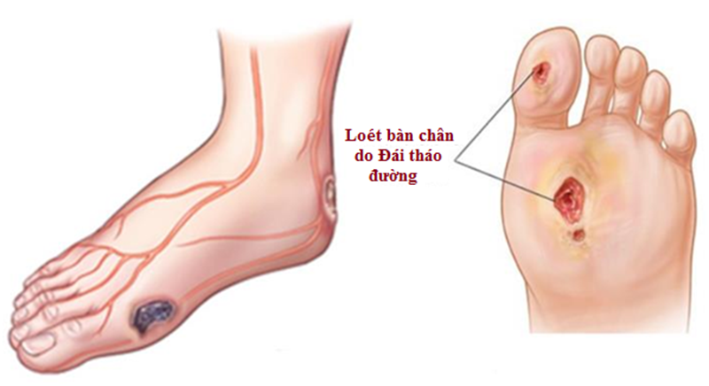 Loét bàn chân có thể dẫn đến cụt chân ở bệnh tiểu đường