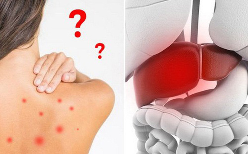 Dấu hiệu cảnh báo bệnh gan - bí quyết tăng cường chức năng gan